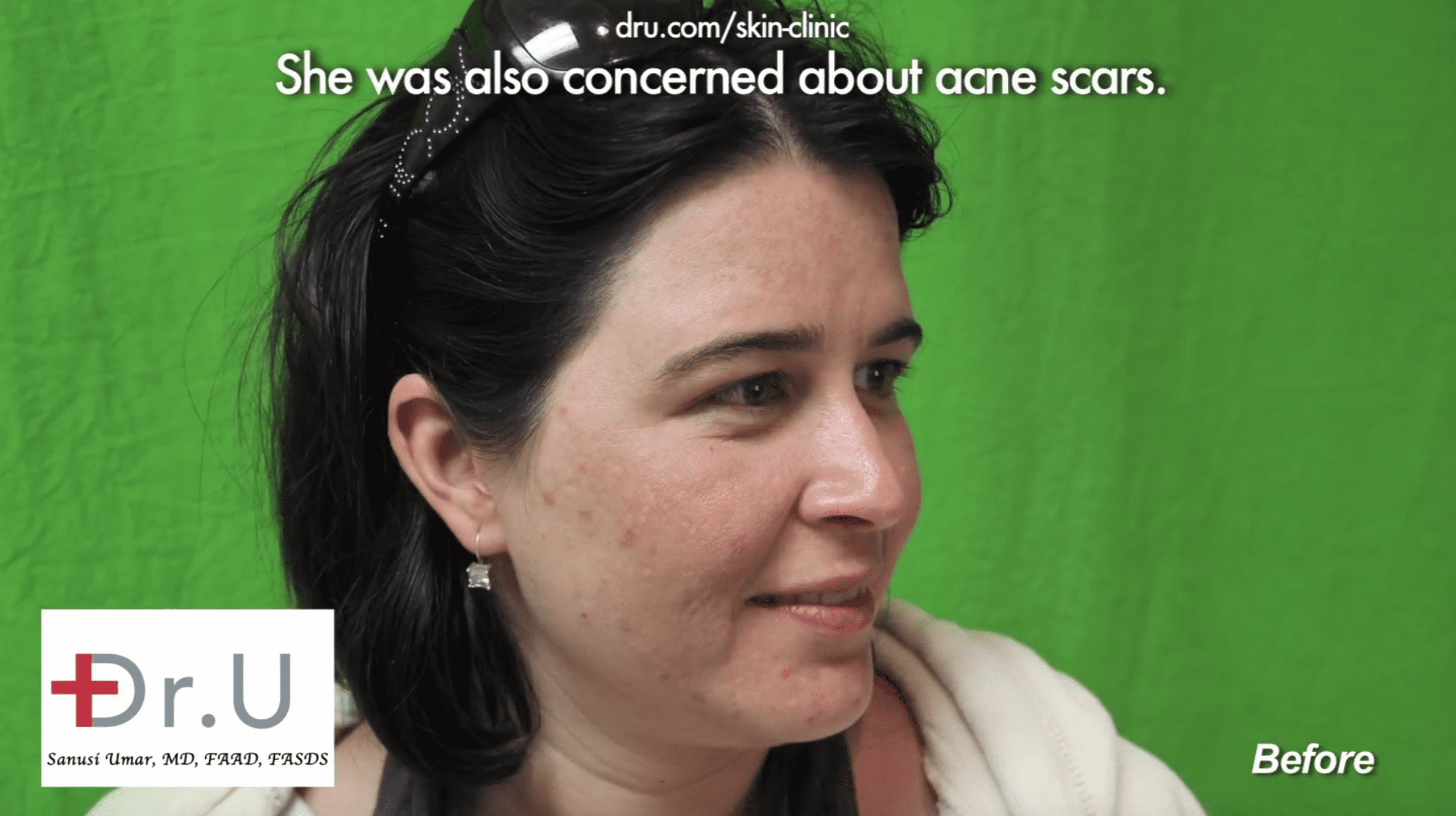 The patient’s acne-prone skin prior to adult acne treatment at Dr. U Skin Clinic The patient’s acne-prone skin prior to adult acne treatment at Dr. U Skin Clinic