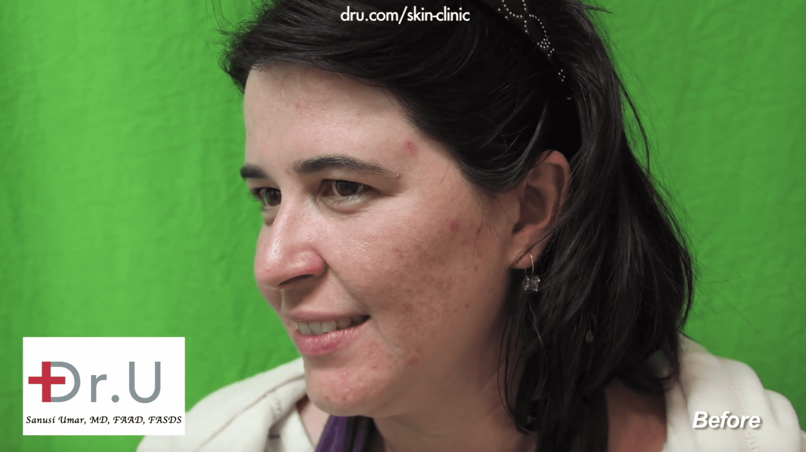 Unknown adult acne causes left this patient with broken skin before finding Dr. U Skin Clinic. Unknown adult acne causes left this patient with broken skin before finding Dr. U Skin Clinic.