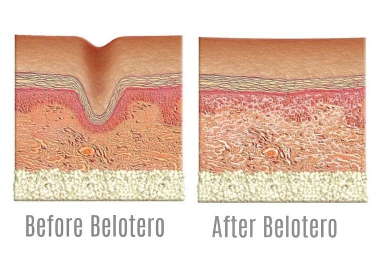 How Belotero works for forehead creases and other wrinkles. Image - Belotero.com