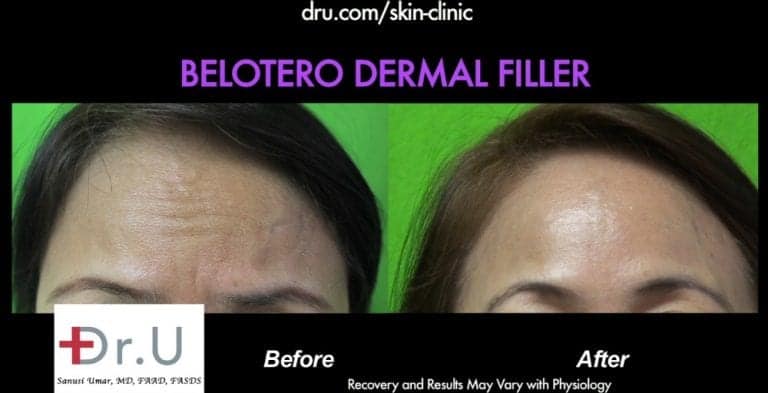 Forehead furrows are no longer apparent on the patient * Forehead furrows are no longer apparent on the patient.*