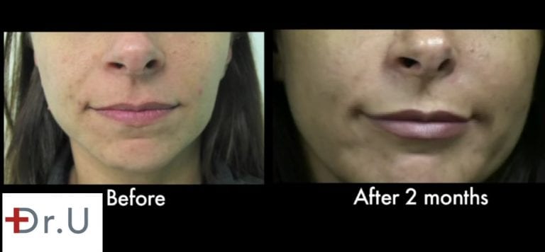 Patient is happy with her laugh line treatment results at two months.* Patient is happy with her laugh line treatment results at two months.*