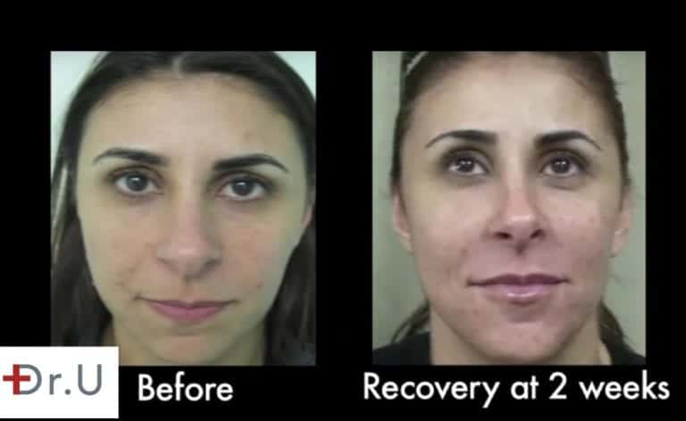 Patient shows excellent healing and improvement of her laugh lines at 2 weeks * Patient shows excellent healing and improvement of her laugh lines at 2 weeks *