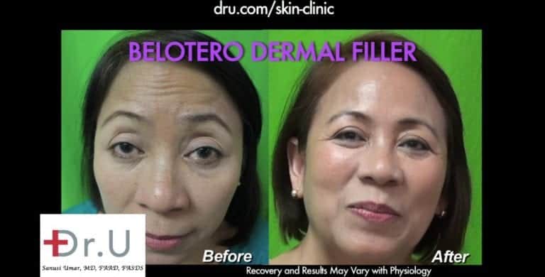 Dr. U's treatment with Belotero for forehead wrinkles helped this patient look her absolute best. Dr. U's treatment with Belotero for forehead wrinkles helped this patient look her absolute best.