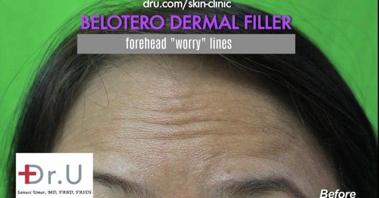 Manhattan Beach patient hopes for improvement using Belotero for forehead wrinkles