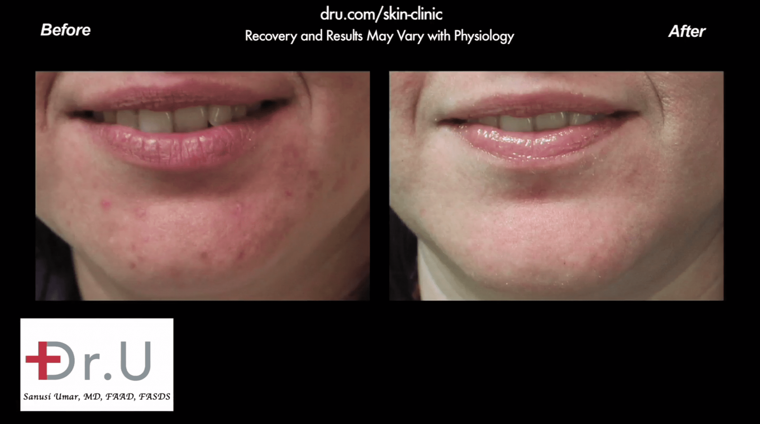 Before and after patient received one of the best acne treatment products for adults. Before and after patient received one of the best acne treatment products for adults.