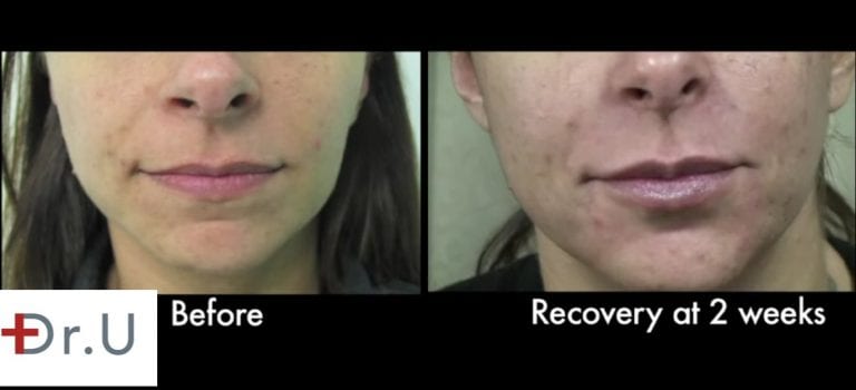 Close up view before and after Dr. U's laugh line filler treatment.* Close up view before and after Dr. U's laugh line filler treatment.*