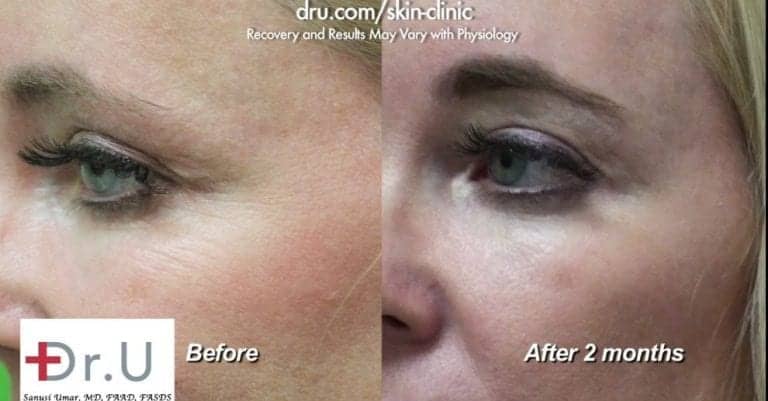 Botox for crows feet helped eliminate static lines. Botox for crows feet helped eliminate static lines.
