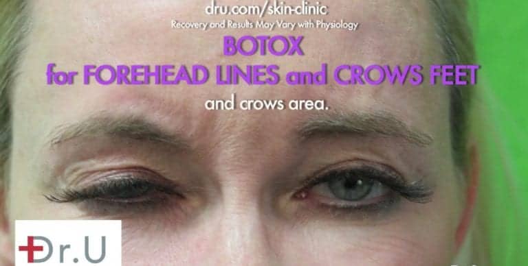 Patient before her Botox for crows feet treatment Patient before her Botox for crows feet treatment.
