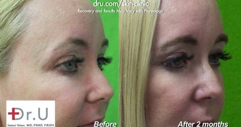 Botox patient before and after crows feet.* Botox patient before and after crows feet.*