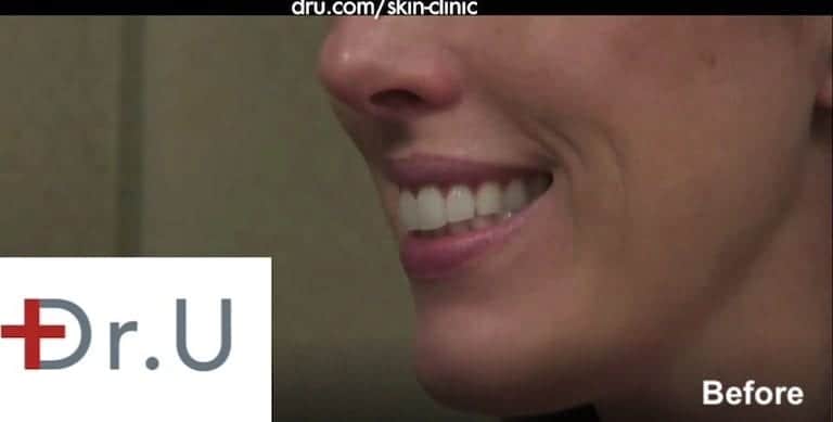 Patient showing onset of deep laugh lines around the mouth