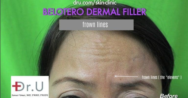 Manhattan Beach, Los Angeles patient wants to get rid of frown lines with Belotero.