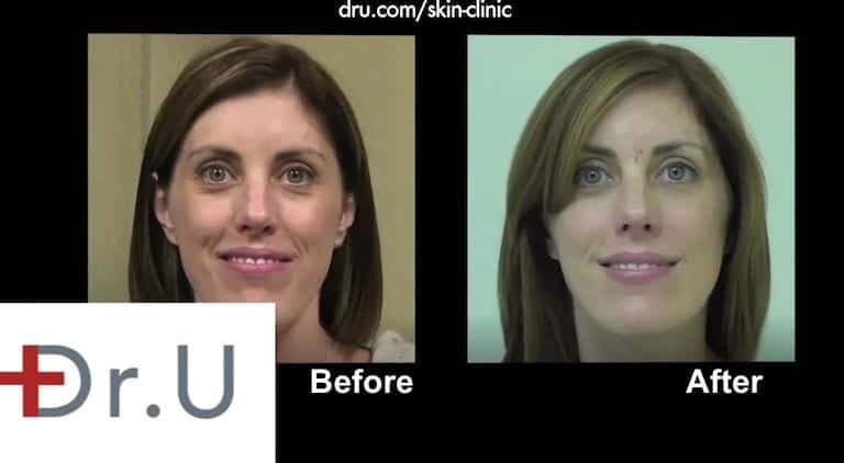 It is possible for hyaluronic acid fillers for laugh lines to soften and improve facial expressions.
