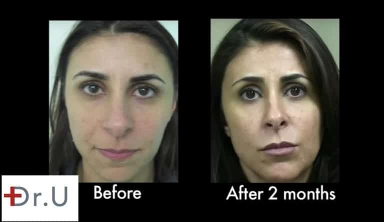 At two months, the hyaluronic acid laugh lines filler continues to produce natural looking results.* At two months, the hyaluronic acid laugh lines filler continues to produce natural looking results.*