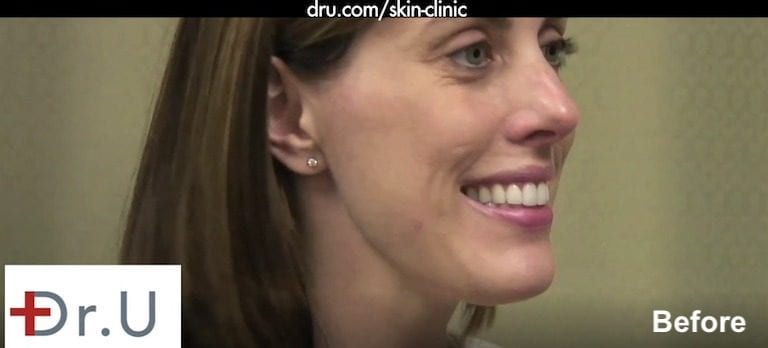 Right side of patient's face before treatment with hyaluronic acid fillers for laugh lines Right side of patient's face before treatment with hyaluronic acid fillers for laugh lines