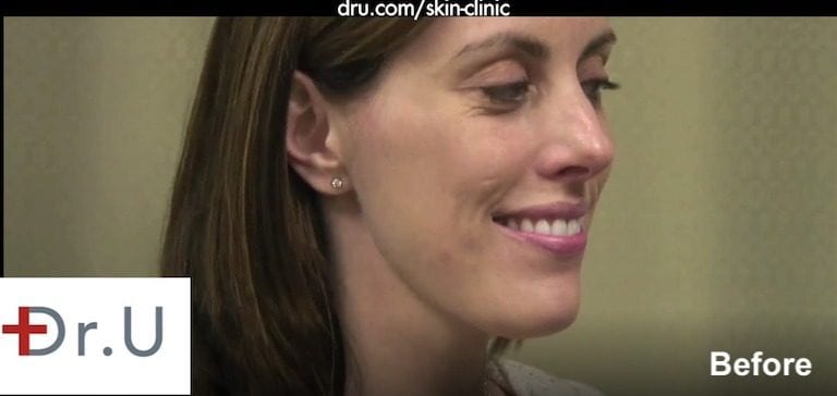 The question of how to get rid of laugh lines can be answered by replenishing the reduced facial volume which contributes to them.