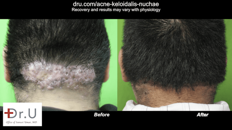 Los Angeles patient is happy to be rid of his AKN, initially mistaken for bumps on scalp after haircut. Los Angeles patient is happy to be rid of his AKN, initially mistaken for bumps on scalp after haircut.