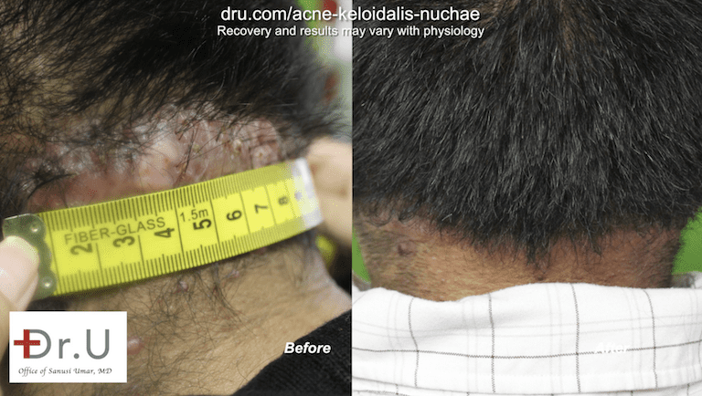 Dr. U used his unique excision shape for this patient's AKN hair bumps on back of head. Dr. U used his unique excision shape for this patient's AKN hair bumps on back of head.*