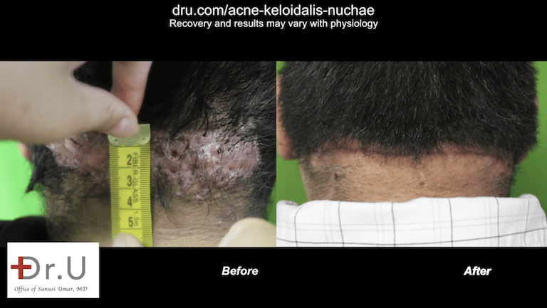 Before and after results of Los Angeles patient at Dr. U Skin Clinic. The patient was happy to be free of razor bumps on head, which had previously made him self-conscious. Before and after results of Los Angeles patient at Dr. U Skin Clinic. The patient was happy to be free of razor bumps on head, which had previously made him self-conscious.