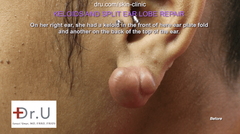 This Manhattan Beach, Los Angeles patient consulted Dr. U about her keloid + split earlobe repair. Previous treatment in another clinic failed to remove her earlobe keloid successfully.