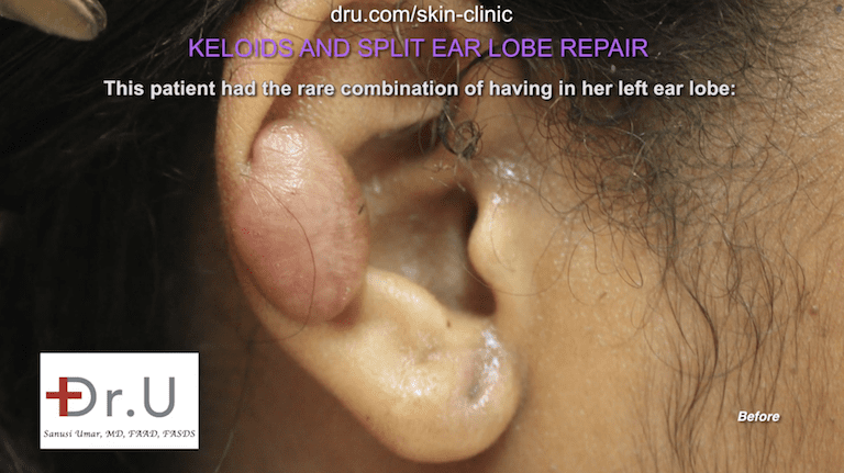On the other ear, the patient also had an earlobe keloid towards the top of the front of her ear. This was a source of concern and embarrassment for the patient. On the other ear, the patient also had an earlobe keloid towards the top of the front of her ear. This was a source of concern and embarrassment for the patient.