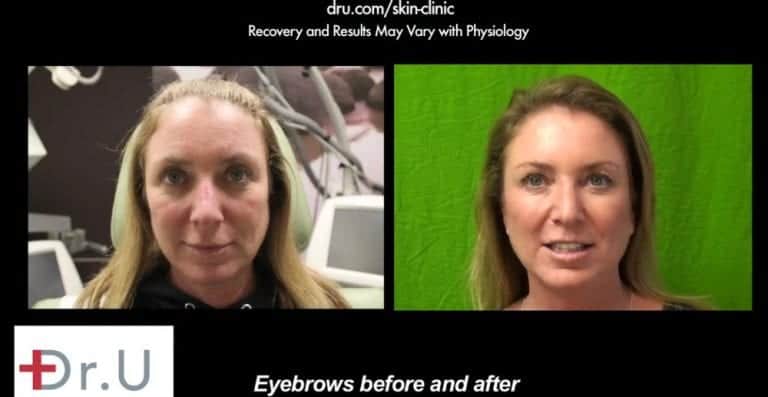 Before and after Botox for eyebrow lift. The El Segundo, Los Angeles patient is happy and no longer wonders ,"how long does Botox last on the crows feet area? Before and after Botox for eyebrow lift. The El Segundo, Los Angeles patient is happy and no longer wonders ,"how long does Botox last on the crows feet area?*