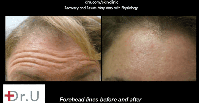 Botox helped El Segundo patient achieve a smoother forehead. Botox helped El Segundo patient achieve a smoother forehead.