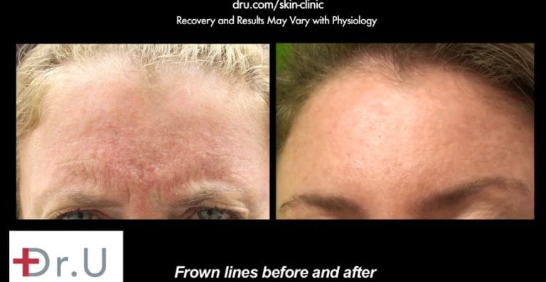 Many patients wonder, "is Botox safe for crows feet?". Your dermatologist can go over your concerns in an initial consultation. This patient was happy wih how Dr. U used Botox to rejuvenate the glabellar region by targeting the patient's frown line wrinkles. Many patients wonder, "is Botox safe for crows feet?". Your dermatologist can go over your concerns in an initial consultation. This patient was happy wih how Dr. U used Botox to rejuvenate the glabellar region by targeting the patient's frown line wrinkles.*
