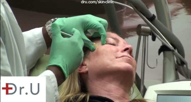 Dr. U injects Botox for crows feet around the eyes. Dr. U injects Botox for crows feet around the eyes