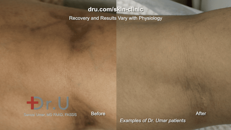 Close up view of Dr. U patient result after varicose vein removal. While spider veins on legs are more common, they can also appear on other parts of the body, such as the forearm.