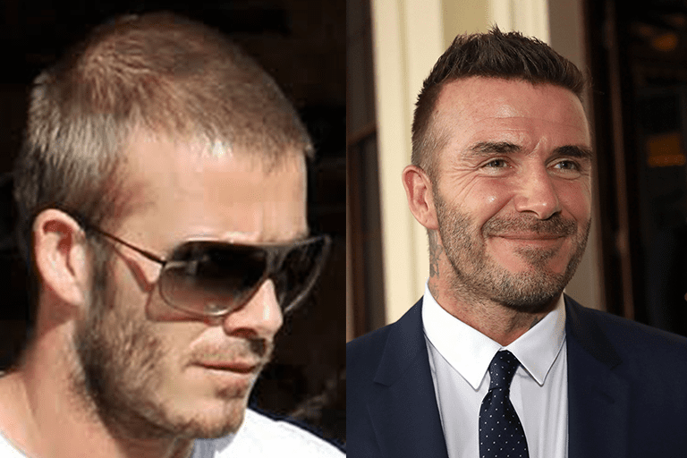 The photo on the left appears to show signs of thinning along the top of the head. A recent photo of Beckham (right) seems to show a straighter, more dense hairline, according to several sources. This has ignited speculation and searches around David Beckham hair transplant procedures. The photo on the left appears to show signs of thinning along the top of the head. A recent photo of Beckham (right) seems to show a straighter, more dense hairline, according to several sources. This has ignited speculation and searches around David Beckham hair transplant procedures.
