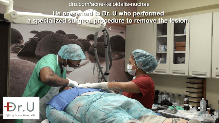 Dr. U removes razor bump back of head for Los Angeles patient. Using his unique excision method, Dr. U helps encourage a cosmetically acceptable scar along the back hairline. Dr. U removes razor bump back of head for Los Angeles patient. Using his unique excision method, Dr. U helps encourage a cosmetically acceptable scar along the back hairline.