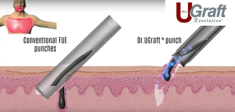 A Dr.UGraft ™ hair transplant with a natural hairline is able to use grafts from the leg, nape or other areas of the body using specialized technology. A Dr.UGraft ™ hair transplant with a natural hairline is able to use grafts from the leg, nape or other area of the body using specialized technology.