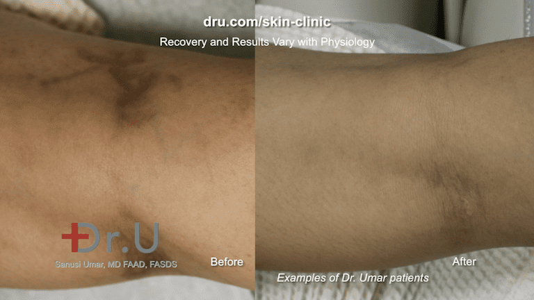 Before and after varicose veins in forearms treatment. This patient was treated by our team for spider veins, which may be associated with deep veins of the leg.* Before and after varicose veins in forearms treatment. This patient was treated by our team for spider veins, which may be associated with deep veins of the leg.*