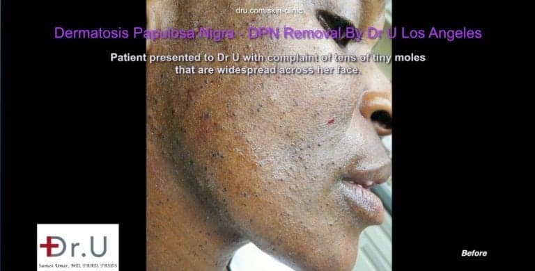 Dermatosa Papulosa Nigra pictures of Westchester patient show numerous lesions on her face. Dermatosa Papulosa Nigra pictures of Westchester patient show numerous lesions on her face.