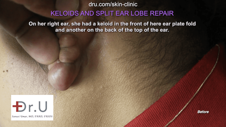 In addition to the earlobe keloid on her right ear, the patient had another on the back, on top. In addition to the earlobe keloid on her right ear, the patient had another on the back, on top.