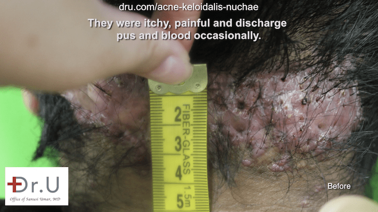 For large razor bumps on head that have joined together, Dr. U typically recommends surgical removal. For large razor bumps on head that have joined together, Dr. U typically recommends surgical removal.