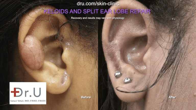 The Manhattan Beach patient wanted to know how to get rid of keloids from ear piercings, and if she would be able to wear earrings again after the removal procedure. Dr. U addressed her concerns in an initial consultation and the "after" photo above shows that she can indeed wear earrings again. The Manhattan Beach patient wanted to know how to get rid of keloids from ear piercings, and if she would be able to wear earrings again after the removal procedure. Dr. U addressed her concerns in an initial consultation and the "after" photo above shows that she can indeed wear earrings again.