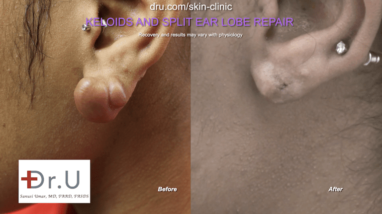 Home remedies for keloid scars on earlobes are not likely to be effective, which is why this patient sought expert care by Dr. U and his medical staff. Home remedies for keloid scars on earlobes are not likely to be effective, which is why this patient sought expert care by Dr. U and his medical staff.