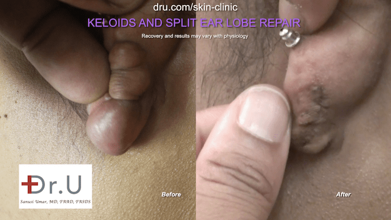Frustrated with home remedies on how to get rid of keloids on ear, the Manhattan Beach patient turned to Dr. U for treatment. His unique and expertly executed removal methods allowed for the shape of the earlobe to be kept intact. Frustrated with home remedies on how to get rid of keloids on ear, the Manhattan Beach patient turned to Dr. U for treatment. His unique and expertly executed removal methods allowed for the shape of the earlobe to be kept intact.