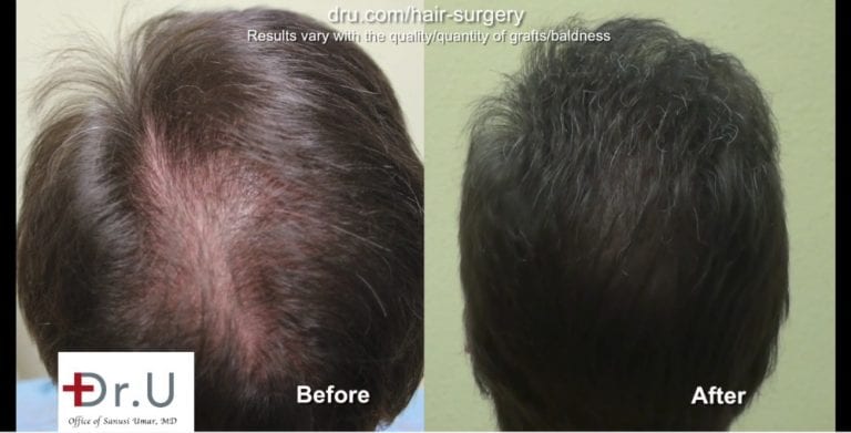 Results like these before and after photos have earned Dr.U many positive natural hair transplant reviews. Results like these before and after photos have earned Dr.U many positive natural hair transplant reviews.