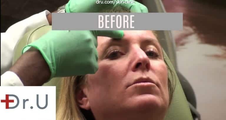 El Segundo, Los Angeles patient before Botox for eyebrow lift, crows feet, frown lines & forehead wrinkles. El Segundo, Los Angeles patient before Botox for eyebrow lift, crows feet, frown lines & forehead wrinkles.