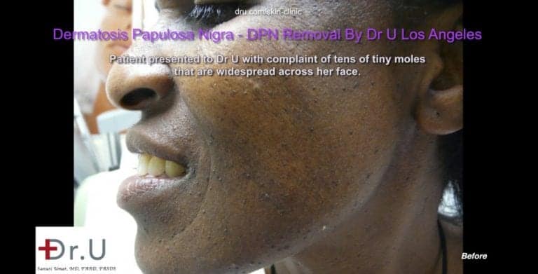 The appearance of dark skin tags on the face is due to Dermatosa Papulosa Nigra which develop over time due to genetic and environmental influences The appearance of dark skin tags on the face is due to Dermatosa Papulosa Nigra which develop over time due to genetic and environmental influences