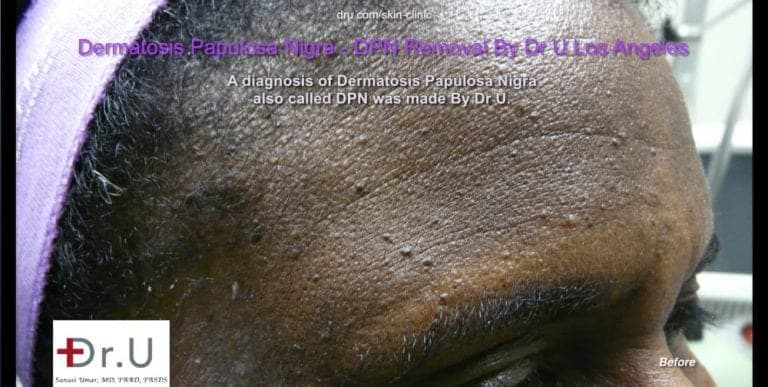 DPN lesions which look like skin tags on the face appear across patient's forehead DPN lesions which look like skin tags on the face appear across patient's forehead.