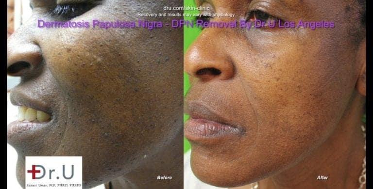 Left side comparison photos shows a major clearance of dark skin tags on the face. Left side comparison photos shows a major clearance of dark skin tags on the face.