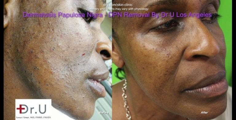 Dermatosa Papulosa Nigra pictures show smoother skin following Dr.U's treatment. Dermatosa Papulosa Nigra pictures show smoother skin following Dr.U's treatment.