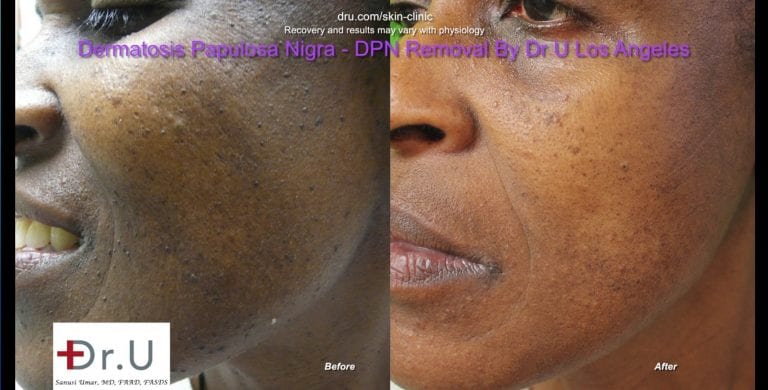 Closeup view showing clearance of dark skin tags on the face. Closeup view showing clearance of dark skin tags on the face.
