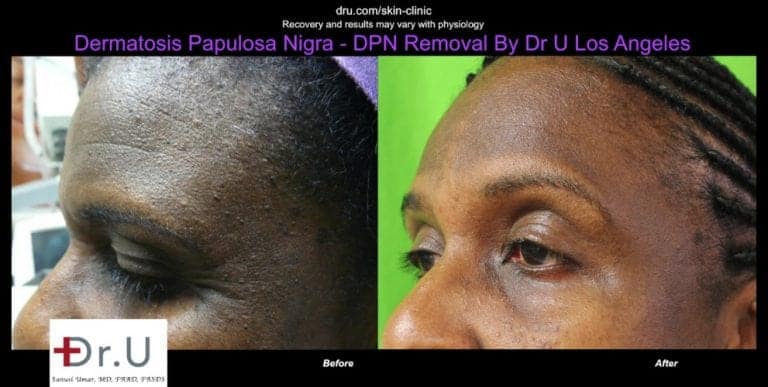 Dermatosa Papulosa Nigra pictures show a smoother looking forehead after Dr.U's electrocautery procedure. Dermatosa Papulosa Nigra pictures show a smoother looking forehead after Dr.U's electrocautery procedure.