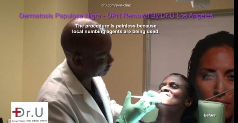 Dr. U uses low current electrocautery to remove DPN lesions. The technique can also be used for general skin tags on the face. Dr. U uses low current electrocautery to remove DPN lesions. The technique can also be used for general skin tags on the face.