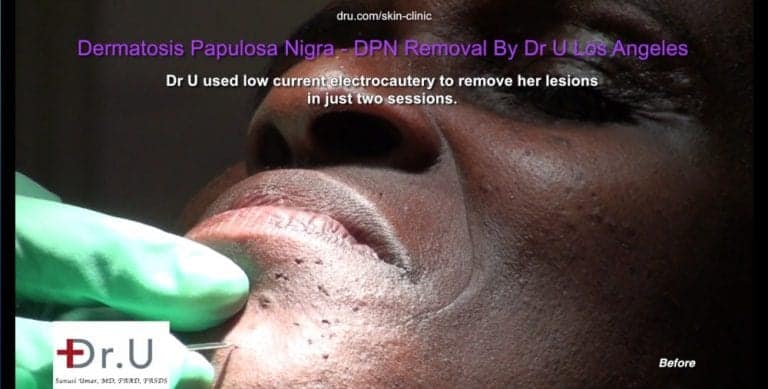 Electrocautery burns and seals blood vessels which feed DPN lesions which look like dark skin tags on the face.