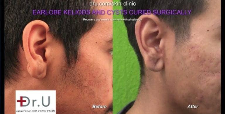 Long Beach, Los Angeles patient before and after his keloid cyst removal procedure performed by Dr. U. Long Beach, Los Angeles patient before and after his keloid cyst removal procedure performed by Dr. U.